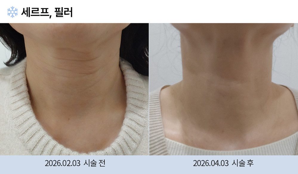 세르프 필러
